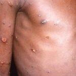 WHO Deklarasikan Virus Cacar Monyet sebagai Darurat Kesehatan Global