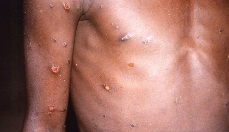 WHO Deklarasikan Virus Cacar Monyet sebagai Darurat Kesehatan Global