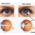 Obat Tetes Mata untuk Katarak: Mitos atau Fakta? Cari Tahu di Sini!