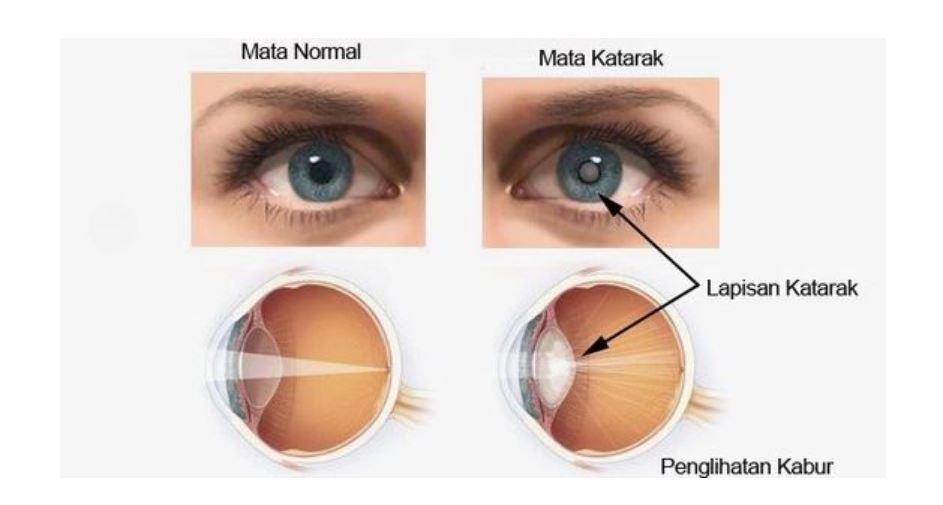 Obat Tetes Mata untuk Katarak: Mitos atau Fakta? Cari Tahu di Sini!